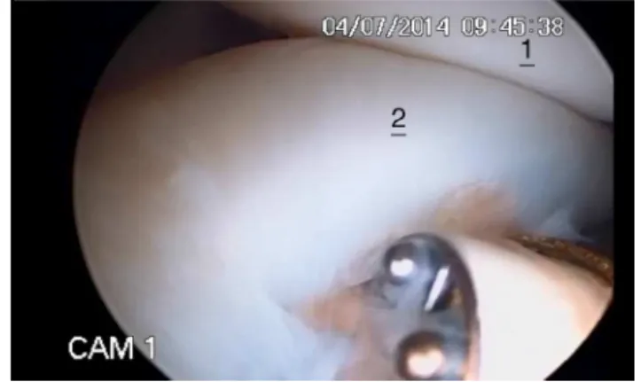 Fig. 5 – Arthroscopic image showing transfixation of the tendon of the subscapularis muscle