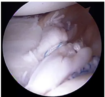 Fig. 2 – Suturing and retensioning of the capsulolabral complex using anchors and high-tension thread.