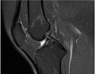 Fig. 4 – Anteroposterior thickness of the ACL in the sagittal plane.