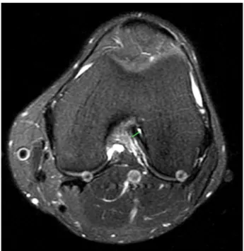 Fig. 5 – Mediolateral thickness of the ACL in the axial plane.