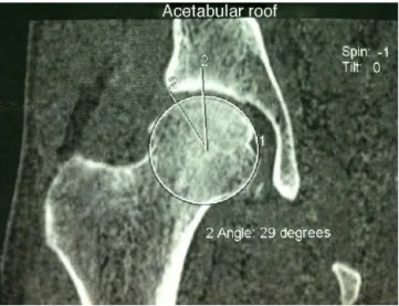 Fig. 2 – Tomographic measurement of the version angle in the cranial or supraequatorial portion of the acetabulum.