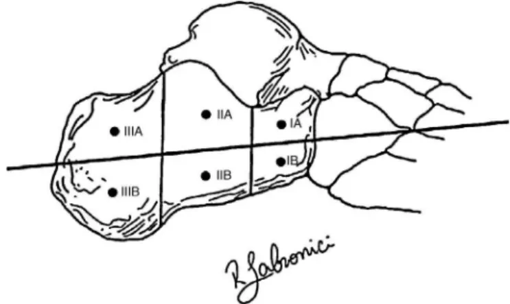 Fig. 1 – Diagram showing the six zones of the calcaneus for calculating the risk of injury to nerves, arteries and veins.