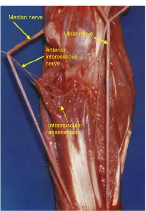 Fig. 8 – In type VI, which was recorded in two limbs, fascicles coming from the branch of the median nerve to the superficial flexor muscle headed toward