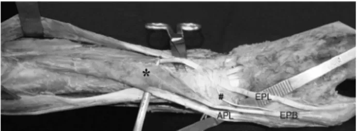 Fig. 1 – Photo showing the left forearm in pronated position. * denotes fused muscle belly of the abductor pollicis longus and extensor pollicis brevis