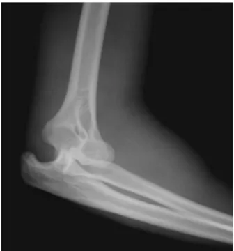 Fig. 1 – Lateral radiograph of the left elbow, showing posterior dislocation and soft-tissue edema.