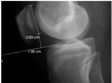 Fig. 1 – Lateral-view radiograph of the knee. Insall–Salvati calculation.