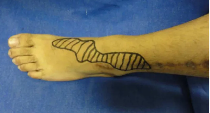 Fig. 9 – Nerve graft positioned between the nerve stumps in an appropriate position for suturing without tension.
