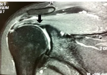 Fig. 1 – Coronal slice from magnetic resonance imaging, highlighting the anomalous origin of the long head of the biceps.