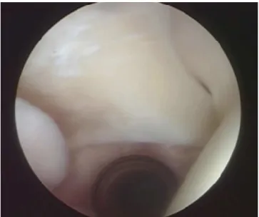 Fig. 3 – Another arthroscopic view, with the probe at the insertion of the biceps.