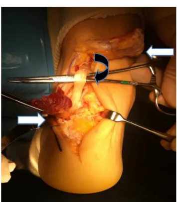 Fig. 2 – Isolation of the long flexor of the hallux (black curved arrow) and long accessory flexor (white arrow on left side) with different tunnels and sheaths