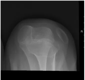 Fig. 3 – Axial X-ray of the left patella.