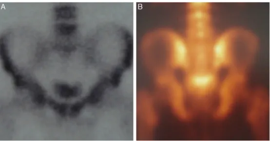 Fig. 3 – Bone scintigraphy with technetium, which did not show the lesion (A and B), thus suggesting that it was of benign nature.