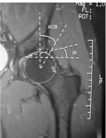 Fig. 3 – CEA and the AI indicative of pincer deformity.