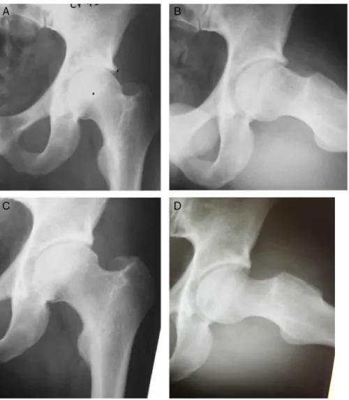 Fig. 1 – Male patient aged 28 years, arthroscopic surgery group. A and B, preoperative radiographic evidence of mixed-type FAI, CE angle: 39 ◦ ; ␣ angle: 64 ◦ 