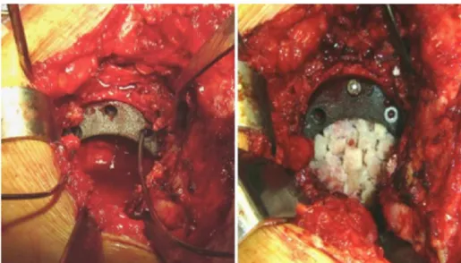 Fig. 1 – On the left, provisional positioning of the tantalum augment with Kirschner wires