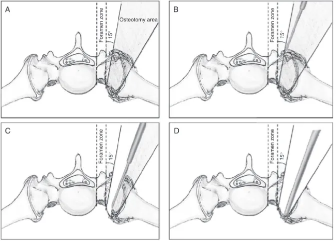 Fig. 2 – Posterior sacroiliac osteotomy. (A) Demonstration of the area of safety and angle of attack of the osteotome for the sequential bone cuts; (B and C) sequential bone resection, with groove creation and maintenance of the thin anterior cortical laye