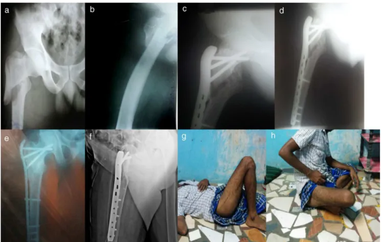 Fig. 3 – (a, b) Radiografia pré-operatória de paciente do sexo masculino de 36 anos, com fratura complexa proximal do fêmur direito; (c, d) raios X pós-operatórios três meses após a fixac¸ão da PF-LCP mostram união tardia e requerem enxerto ósseo adicional