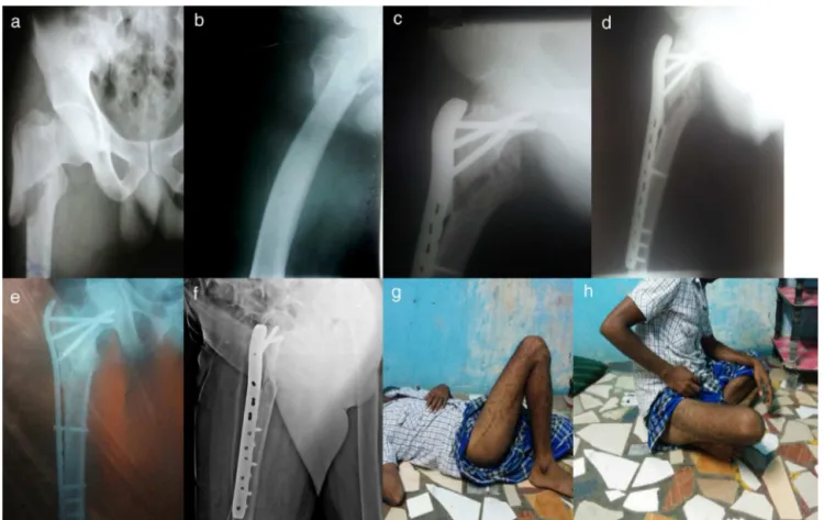 Fig. 3 – (a, b) Pre-operative X-rays of 36 year male with right complex proximal femoral fracture; (c, d) 3 month post-op X-rays after PF-LCP fixation showing delayed union and required additional bone grafting; (e, f) X-rays showing good fracture union at