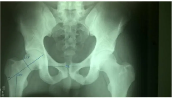 Fig. 1 – Representation of angles measured in an anteroposterior pelvic radiograph.