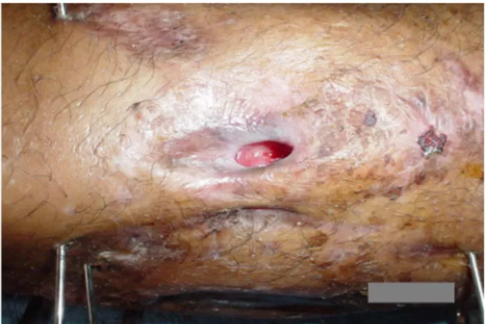 Fig. 1 – Grade 4 pin site infection according to Moore and Dahl classification.