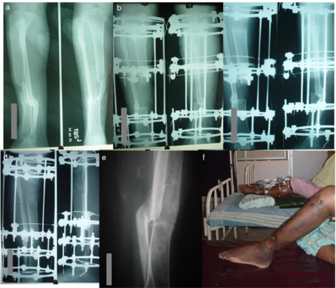 Fig. 3 – (a) A 40 year old male with infected non-union left tibia type IIc of Kulkarni’s classification