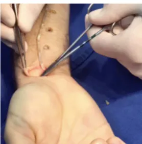 Fig. 2 – Preoperative clinical aspect: incision in the