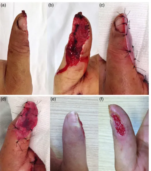 Fig. 2 – Clinical case 2: female patient, 34 years old. Trauma by crushing the middle finger; (a) aspect of the dorsum of the finger with complex nail bed lesion; (b) oblique volar injury (difficult flap use); (c) plastic trimmed into a U-shape; (d) intrao