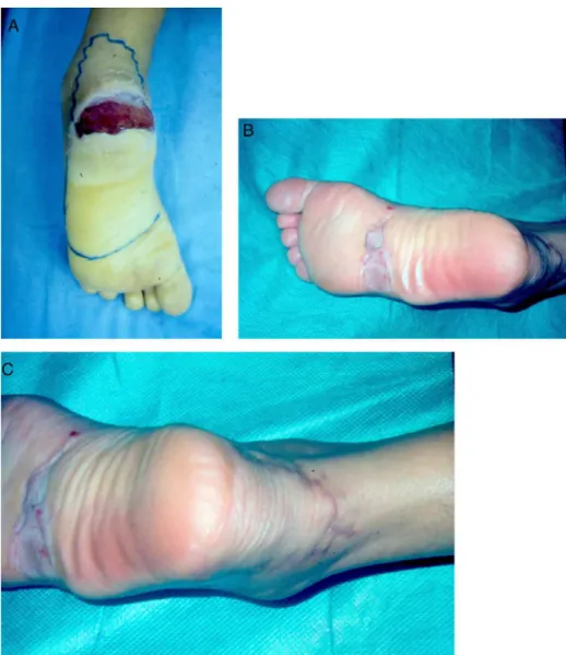 Fig. 3 – (A) 26-Year-old patient, victim of a motorcycle accident with loss of calcaneal substance