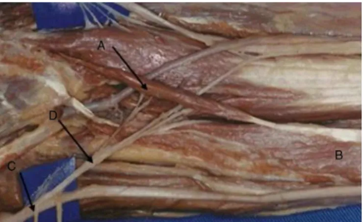 Fig. 3 – By analogy with Gantzer (A) muscle, also called accessory to the flexor pollicis longus (B), which is frequent because it occurs in 68% of the limbs, we call this rare muscle as accessory of the flexor digitorum superficialis.
