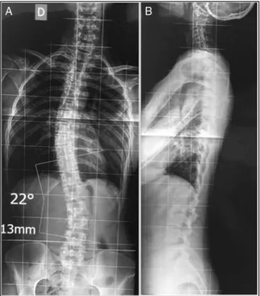 Fig. 1 – (A) Radiografia anteroposterior: escoliose