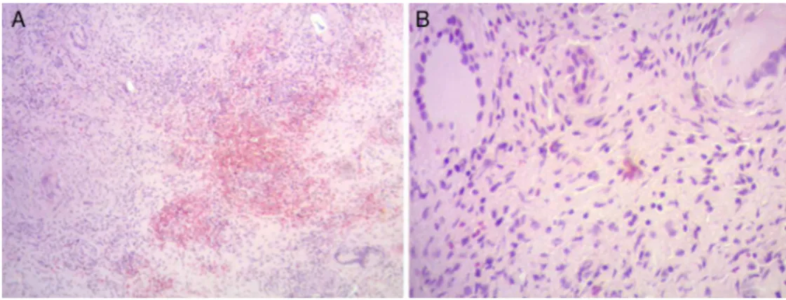 Fig. 5 – (A) Amostra microscópica que mostra a reac¸ão do tecido granulomatoso; (B) Imagem microscópica magnificada de células multinucleadas de granuloma.