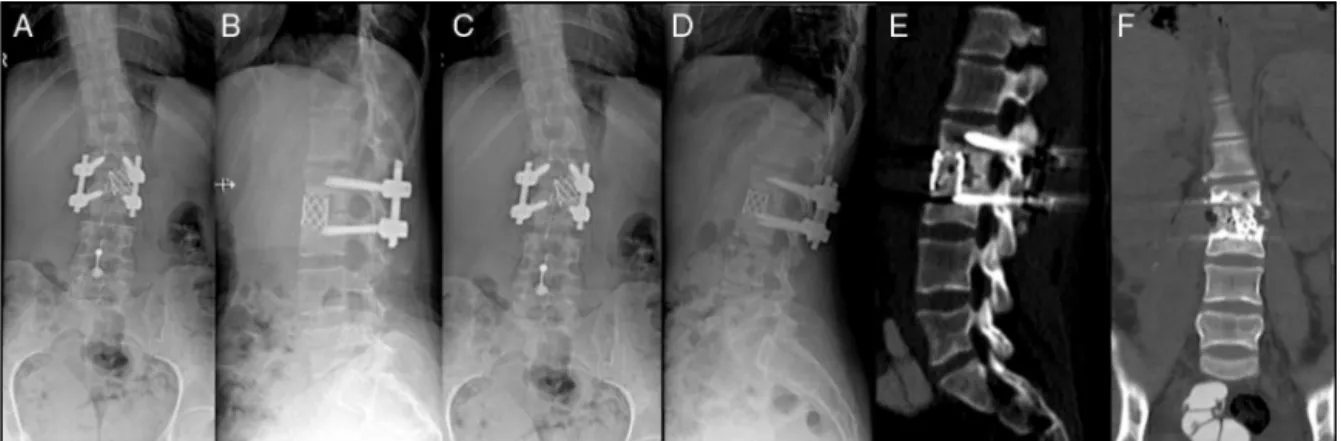 Fig. 6 – (A) e (B) Controle pós-operatório imediato; (C) e (D) controle pós-operatório de um ano; (E) e (F) tomografia computadorizada mostra artrodese intersomática em L2-L3.