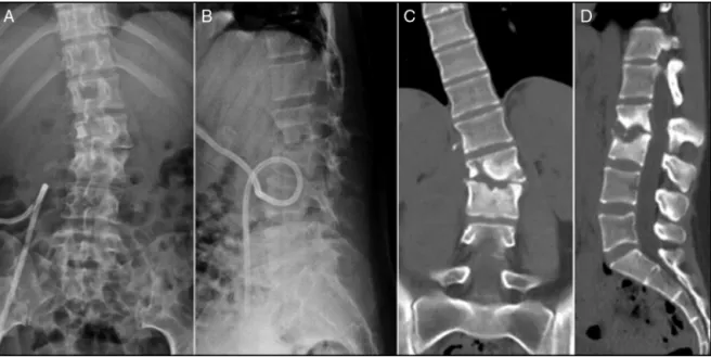 Fig. 3 – (A) and (B) Anterior and lateral lumbar radiological images with a percutaneous catheter utilized to drain right psoas abscess; (C) and (D) CT-scan showing severe compromise of L2–L3 disk space and vertebral bony destruction.
