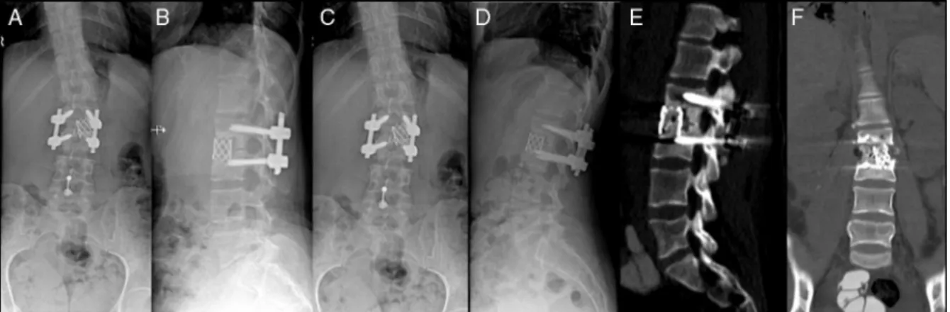 Fig. 6 – (A) and (B) Immediate postoperative control; (C) and (D) One year postoperative control; (E) and (F) CT-scan showing L2–L3 interbody arthrodesis.