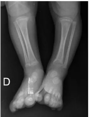 Fig. 2 – (A) Anteroposterior view radiographs of the left ankle, showing no bone changes