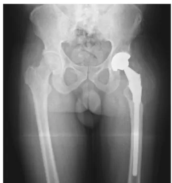 Fig. 2 – Aparência macroscópica do condrossarcoma de células claras recorrente no fêmur proximal esquerdo – abordagens ilioinguinal e lateral na coxa.