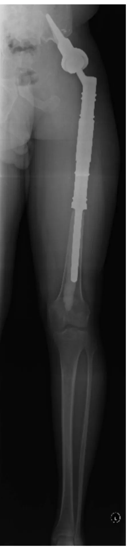 Fig. 9 – Radiografia de membro total aos dez anos de seguimento.