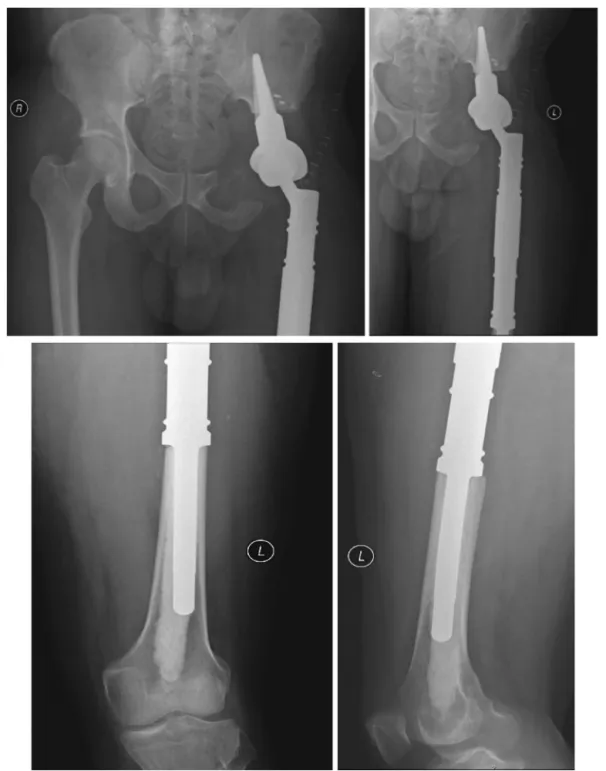 Fig. 8 – Postoperative pelvic and femur radiographs.