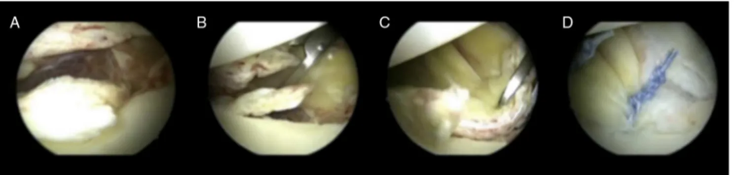 Fig. 1 – Left shoulder, joint view through the posterior portal. (A) Bankart lesion; (B and C) preparation for lesion repair; (D) Bankart lesion arthroscopic repair.