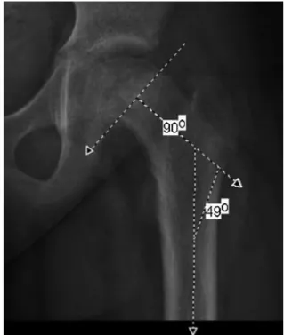 Fig. 3 – (a) Trigonometric formula to determine three-dimensional femoral head–shaft angle; (b) trigonometric formula to determine three-dimensional femoral head–neck angle; (c) trigonometric formula to determine three-dimensional Wilson’s head–neck slip.