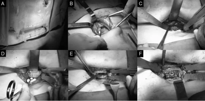 Figura 1 – Imagens representativas do acesso anterior retroperitoneal para acesso ao espac¸o discal L5-S1