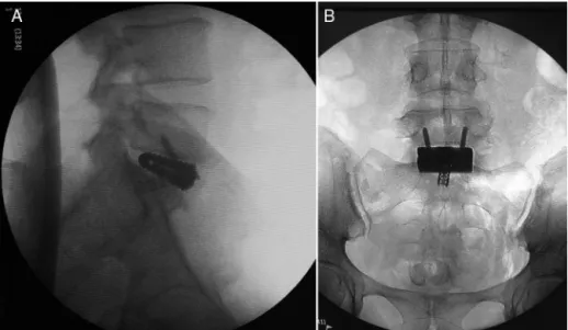 Figura 2 – Imagens de fluoroscopia intraoperatória que mostram posicionamento final do espac¸ador intersomático
