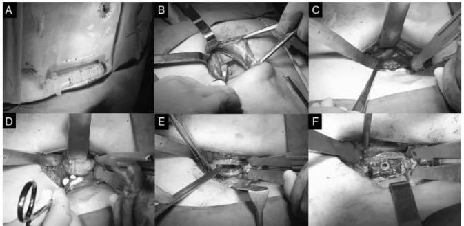 Fig. 1 – Images representing anterior retroperitoneal access to the L5-S1 disc space. (A) Abdominal incision; (B) passage through the abdominal muscles; (C) identification of the bifurcation of the great vessels in front of the disc space of L5S1; (D) expo