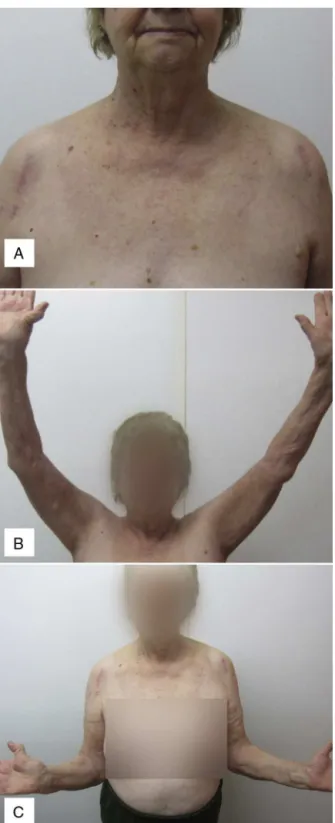 Figura 2 – Avaliac¸ão clínica pós-operatória com três meses, demostra incisão anterolateral (A), elevac¸ão (B) e rotac¸ão externa (C).