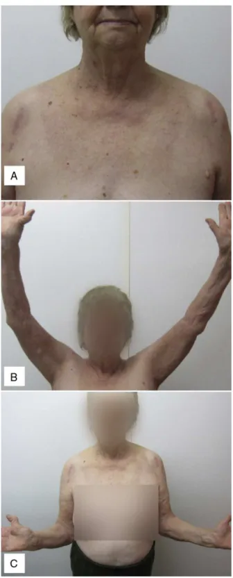 Fig. 2 – Postoperative clinical evaluation at three months demonstrates anterolateral incision (A), elevation (B) and external rotation (C).