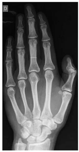 Fig. 1 – Eastern grip used by the patient.