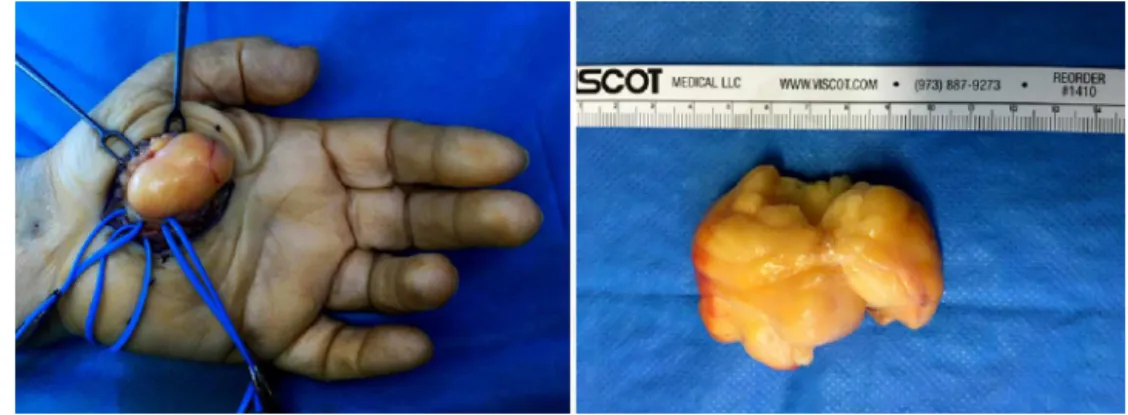 Figura 3 – Imagem intraoperatória do lipoma palmar.
