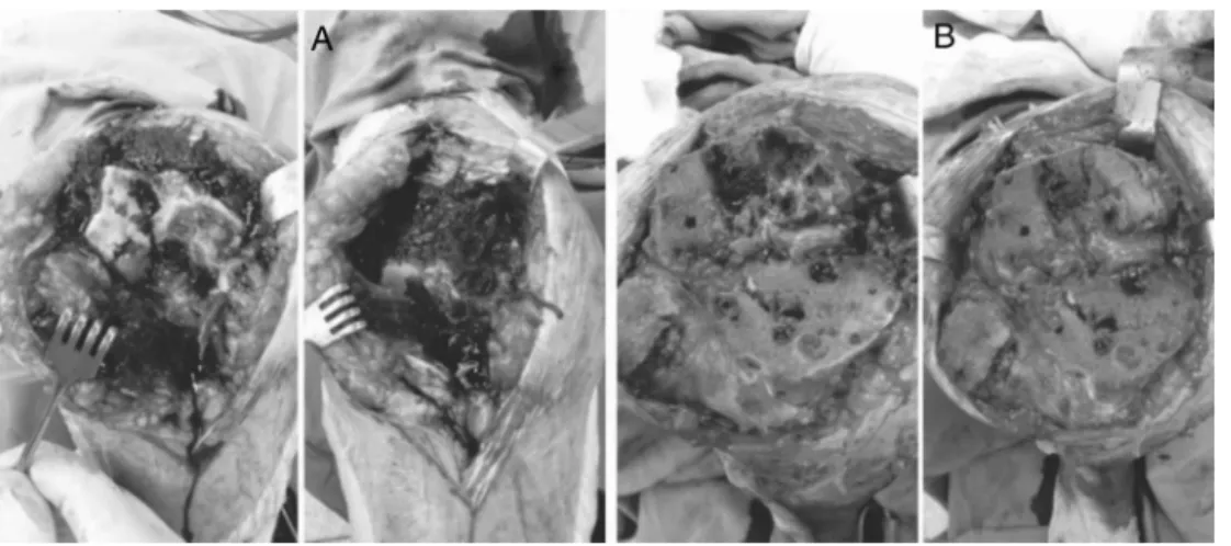 Fig. 2 – Images which demonstrate preoperative aspect – DPVNS, bone flaws and bone sections before (A) and after (B) grafting and wide synovectomy.