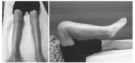 Fig. 4 – Clinical aspect and ROM of the patient with one month after surgery.