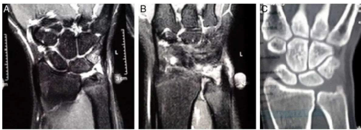 Figura 1 – Imagens do caso 1. A, Ressonância que evidenciando sinovite e edema semilunar e piramidal; B, Lesão da fibrocartilagem triangular na porc¸ão distal apenas; C, Tomografia que demonstra ulna neutra.